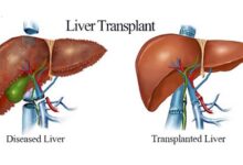 Liver Replacement Surgery India