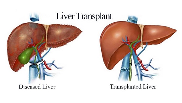 Liver Replacement Surgery India
