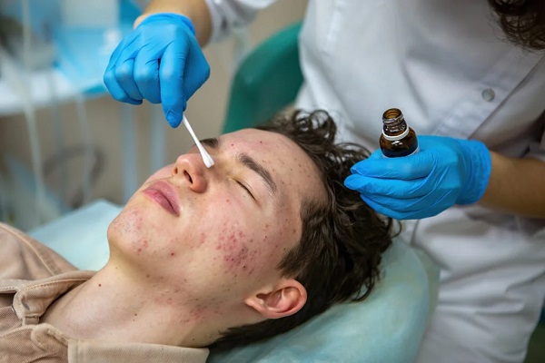 Acne Treatment in Mumbai